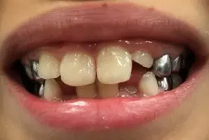 Defects treated with composite fillings.