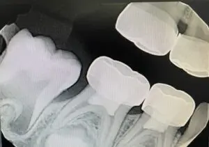 Teeth treated with pulpotomy and crowns.