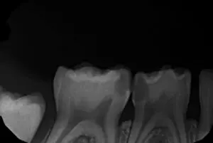 Deep decay causes pulp exposure.