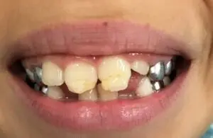 Developmental defect on front teeth.