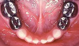 Stainless steel crowns on molars.
